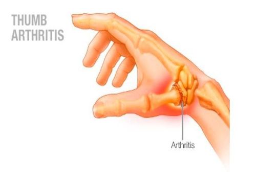 Đau khớp ngón tay cái: Nguyên nhân và phương pháp điều trị hiệu quả