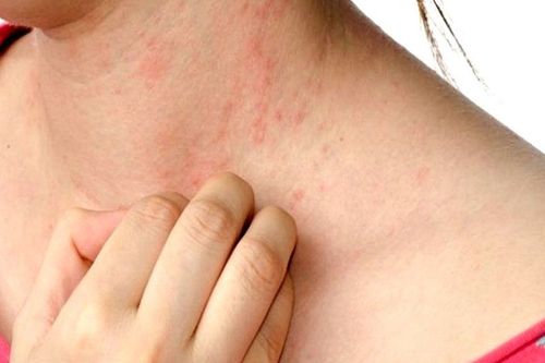 Is itchy skin a sign of cancer?