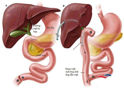 Điều trị teo đường mật bẩm sinh như thế nào?