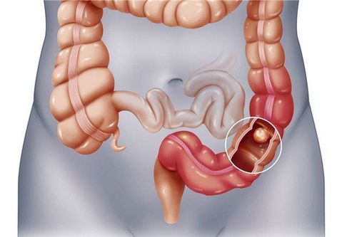 Nghiên cứu đã chỉ ra rằng tình trạng thiếu cân có liên quan tới nguy cơ polyp đại trực tràng