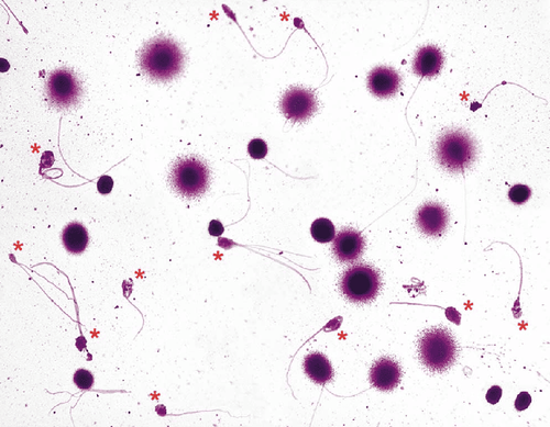 Oxidative stress: the main cause of sperm DNA damage