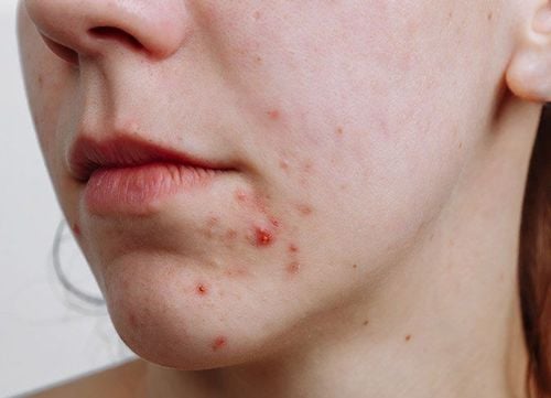 How to squeeze acne to get rid of acne soon?