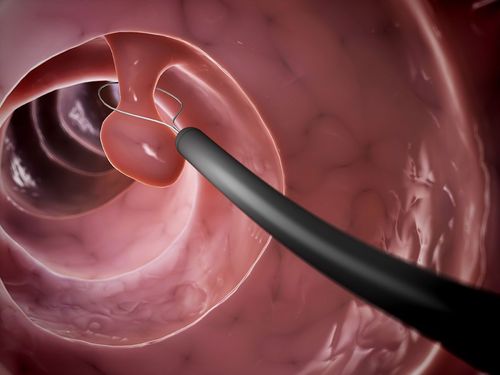 After colorectal polyp removal, what to do?