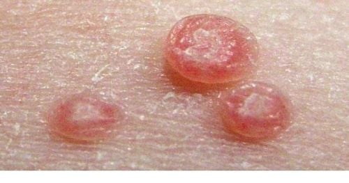 Common diseases that cause nodules on the skin