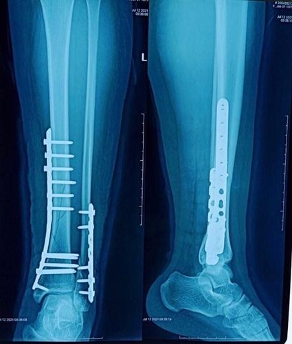 
X-ray images of Ms. Ngoc Y.'s leg before and after surgery
