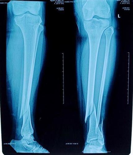 
X-ray images of Ms. Ngoc Y.'s leg before and after surgery
