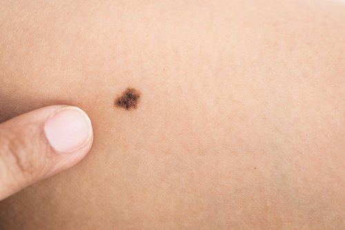 Find out what a mole is and the types of moles