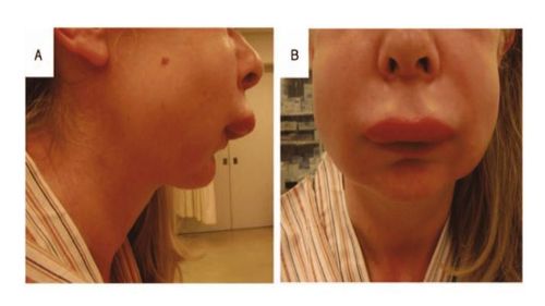 Monitor for hereditary angioedema triggers