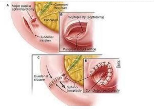 Disorders of the sphincter of Oddi and chronic pancreatitis