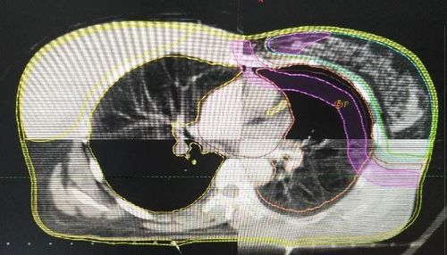 
. Xác minh hình ảnh 3D-CBCT matching theo mô mềm
