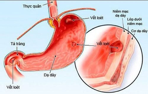 Effective treatment for stomach ulcers?