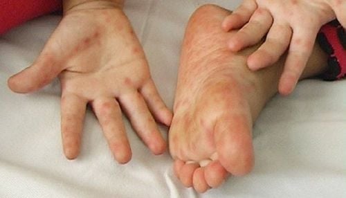 Trẻ 1 tuổi nổi mẩn ngứa ở chân tay là dấu hiệu của bệnh gì?