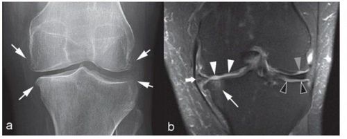 Chụp cộng hưởng từ (MRI) khớp gối giúp chẩn đoán bệnh gì?