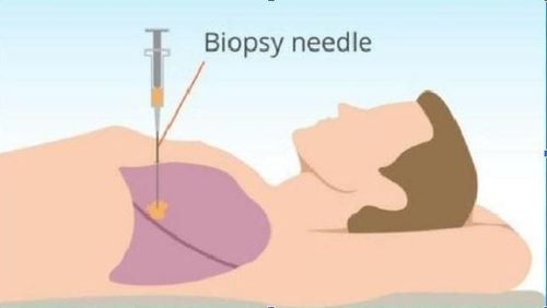 
Sinh thiết xuyên thành dưới hướng dẫn của CT Scan là một trong các phương pháp xác định bản chất u phổi
