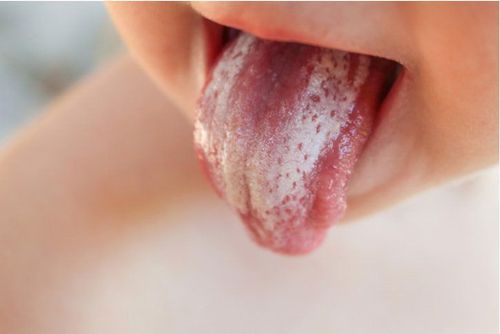 Lưỡi trẻ có nhiều mảng trắng nguyên nhân là gì?