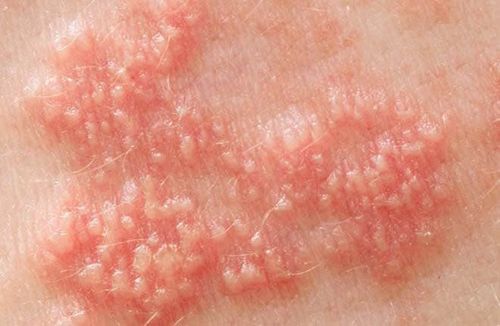 Herpes tái phát kèm lan rộng khắc phục thế nào?