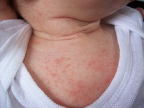 Trẻ 6 tháng nổi mẩn đỏ li ti ở cổ nguyên nhân là gì?
