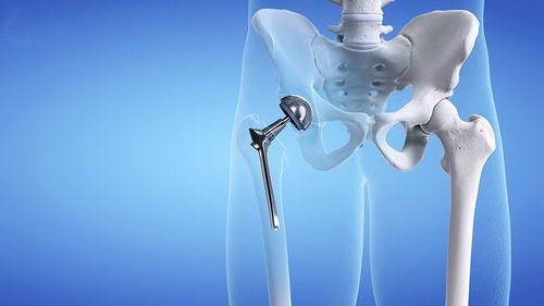 Phẫu thuật thay khớp háng cá thể hóa bằng công nghệ in 3D