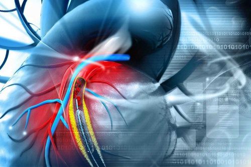 Have you ever had coronary artery disease without chest pain?