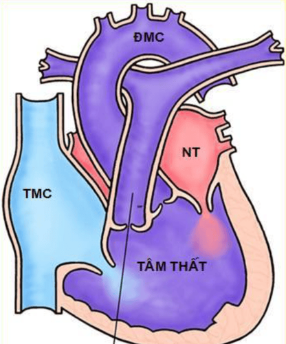 
Hình ảnh mô phỏng tim một thất
