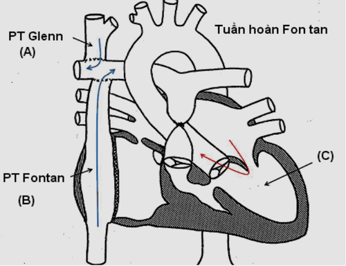 
Phẫu thuật Fontan được áp dụng trong điều trị bệnh tim một thất
