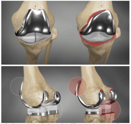 
So sánh khớp gối nhân tạo được chế tạo in 3D (trái) và sản xuất công nghiệp (phải)
