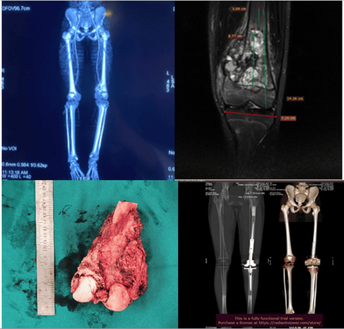 
Khớp gối megaprothesis được ứng dụng trong điều trị ung thư xương
