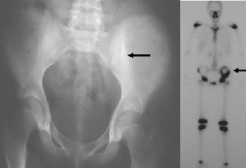 
Ung thư xương chậu được chẩn đoán thông qua X-quang hoặc MRI và PET/CT
