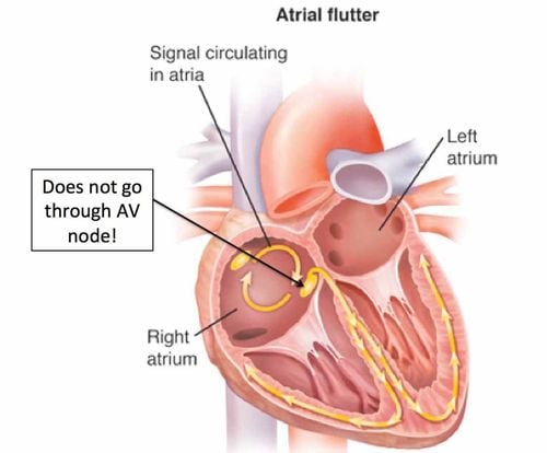 Signs of atrial flutter - common heart disorder