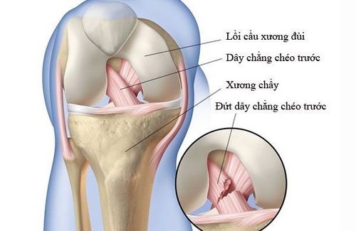 Đứt dây chằng chéo trước và rách sừng sau sụn chêm trong có nghiêm trọng không?