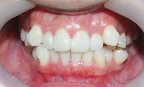 Lệch răng giữa hàm trên và dưới phải làm sao?