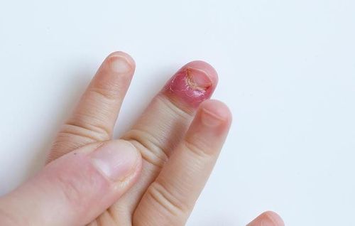 Is it unusual for children to break their fingernails?