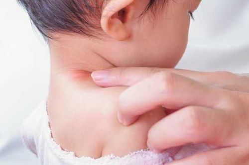 Trẻ hơn 1 tuổi nổi nhiều hạch ở cổ là dấu hiệu bệnh gì?