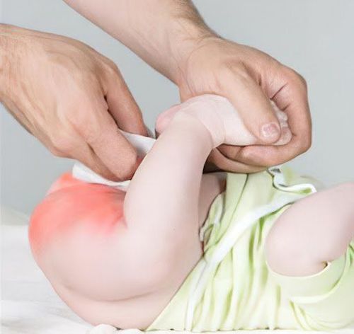 Should children with diaper rash wear diapers?