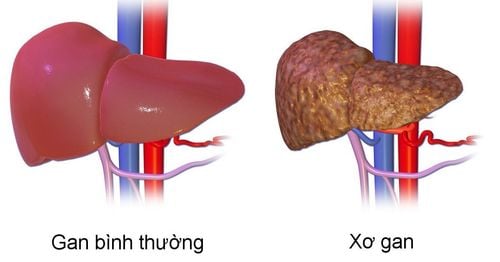 Trẻ xơ gan, giãn tĩnh mạch thực quản độ 2 điều trị như thế nào?