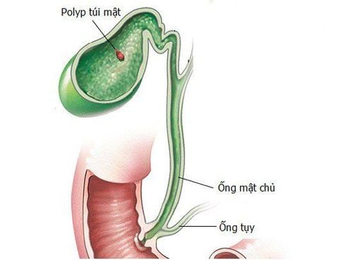 
Hình ảnh mô phỏng Polyp túi mật trên y học lâm sàng
