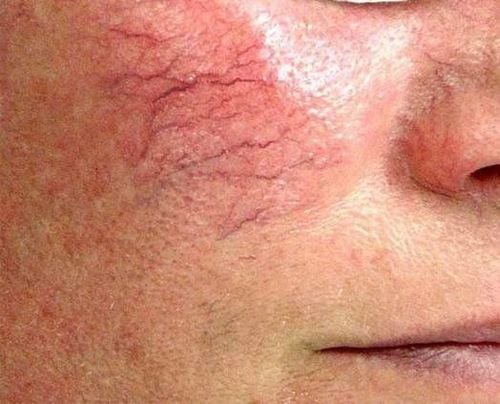 Recognizing varicose veins in the face