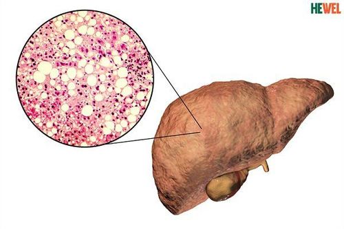 
Có nhiều nguyên nhân khiến cho một người bị gan nhiễm mỡ
