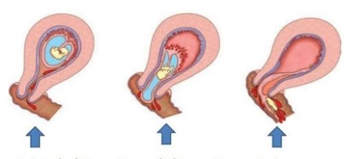 
Một số hình thức sảy thai khó có con lại thường gặp
