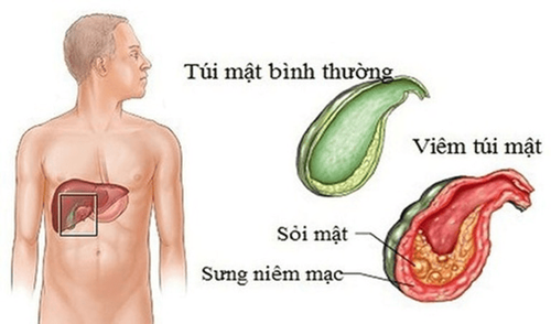 Vị trí đau túi mật ở đâu?