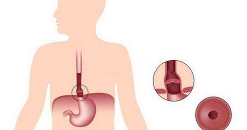 Learn about the Schatzki ring of the esophagus