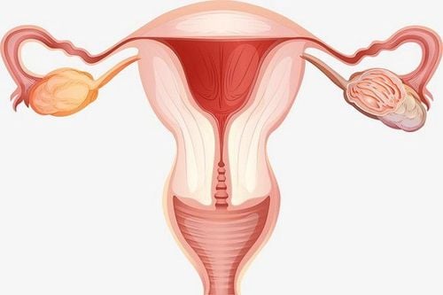 Phụ nữ bị dính buồng tử cung có nguy cơ không thể thụ thai được hoặc sảy thai tự nhiên
