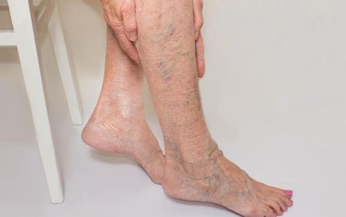 Should you massage when you have varicose veins?