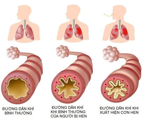 Thuốc điều trị hen suyễn mãn tính có những loại nào?