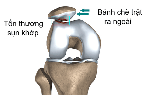 
Hình ảnh: Minh họa trật bánh chè
