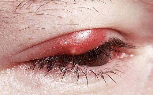 What to do when the eye is stye?