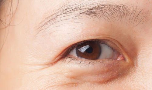 Beware of premature aging of the eyes