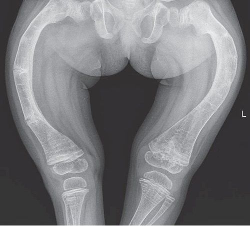 Causes of osteogenesis imperfecta