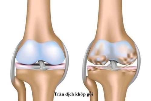 Tràn dịch khớp gối, đau hai khớp mắt cá chân là biểu hiện của bệnh gì?