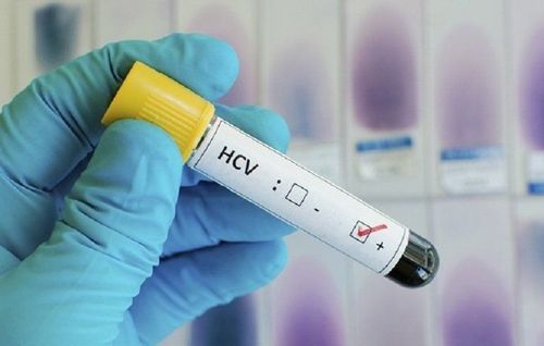 Xét nghiệm anti HCV kết quả định tính có ý nghĩa gì?
